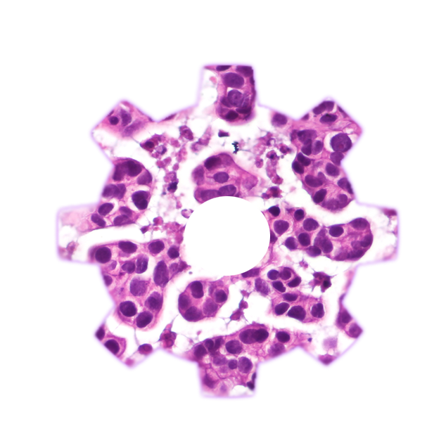 A rotating cog of a histology image featuring pink- and purple-stained urothelial cancer cells.